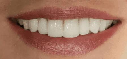 Veneers After